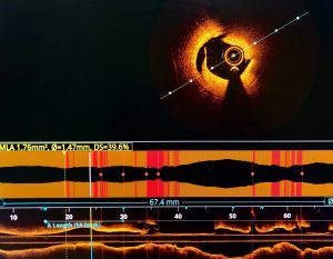 Optical Coherence Tomography Medical Imaging