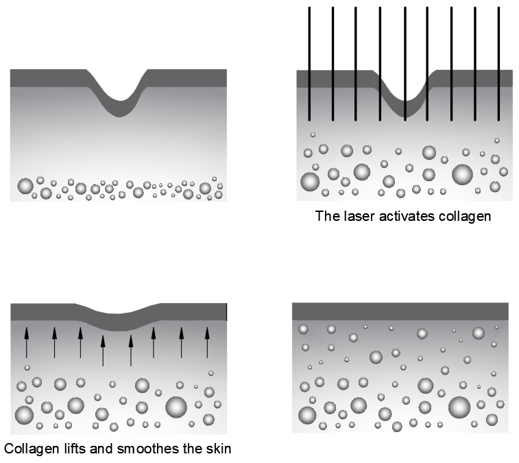 Laser Optics in Skincare, Skin Rejuvenation, tattoo removal