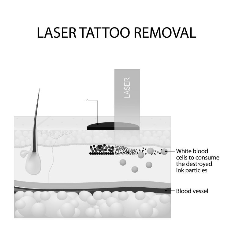 Laser Optics in Skincare, Skin Rejuvenation, tattoo removal